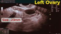 IVF Follicle Detection project thumbnail