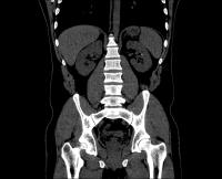 super-small-kidney-stone project thumbnail