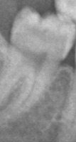 Teeth numbering project thumbnail