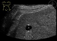 liver project thumbnail