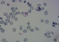 Malaria (no seg and others) project thumbnail