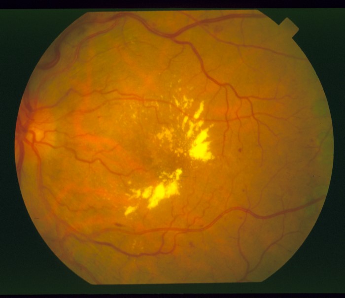 Predicting diseases by eye Object Detection Model by humam