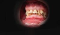 Caries 2 project thumbnail