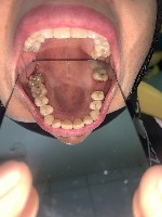 Caries project thumbnail
