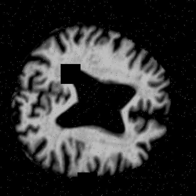 Alz Api ALZ Diseases Object Detection Model by MRI Diseases