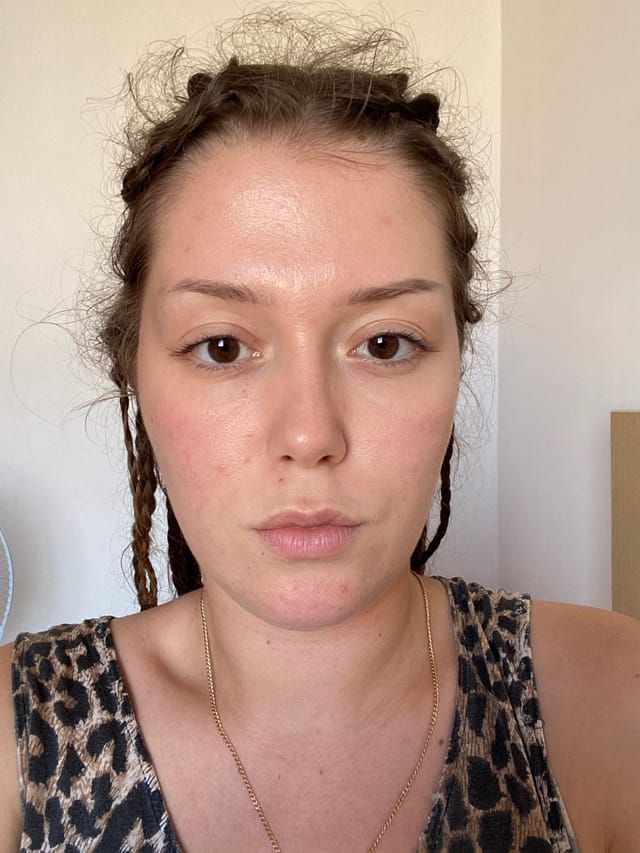 Skin_defects Instance Segmentation Model by Screenique