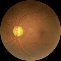 Glaucoma Datasets project thumbnail