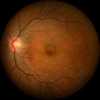 Glaucoma Diagnosis project thumbnail