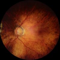 Glaucoma Datasets project thumbnail