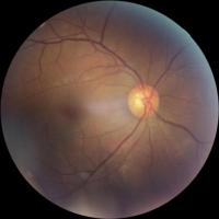 Glaucoma Datasets project thumbnail