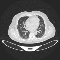 CTscan-lung project thumbnail