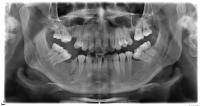 Periodontitis-Apical-Dataset1000 project thumbnail