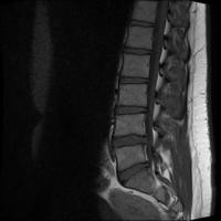 lumbar_cv_l1-to-l5-detection project thumbnail