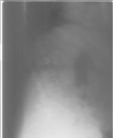 roboflow_nhanes_l1_to_l5_detection project thumbnail