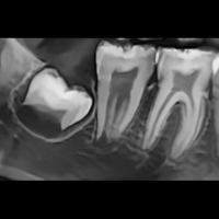 molar project thumbnail