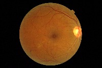 Retinal Fundus project thumbnail
