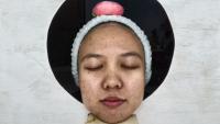 hyperpigmentation project thumbnail
