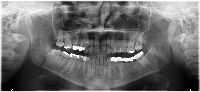 Coronas, Endodoncias, Caries, impactados project thumbnail