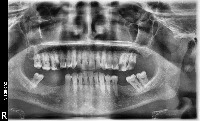 teeth_quadrant_enumeration project thumbnail