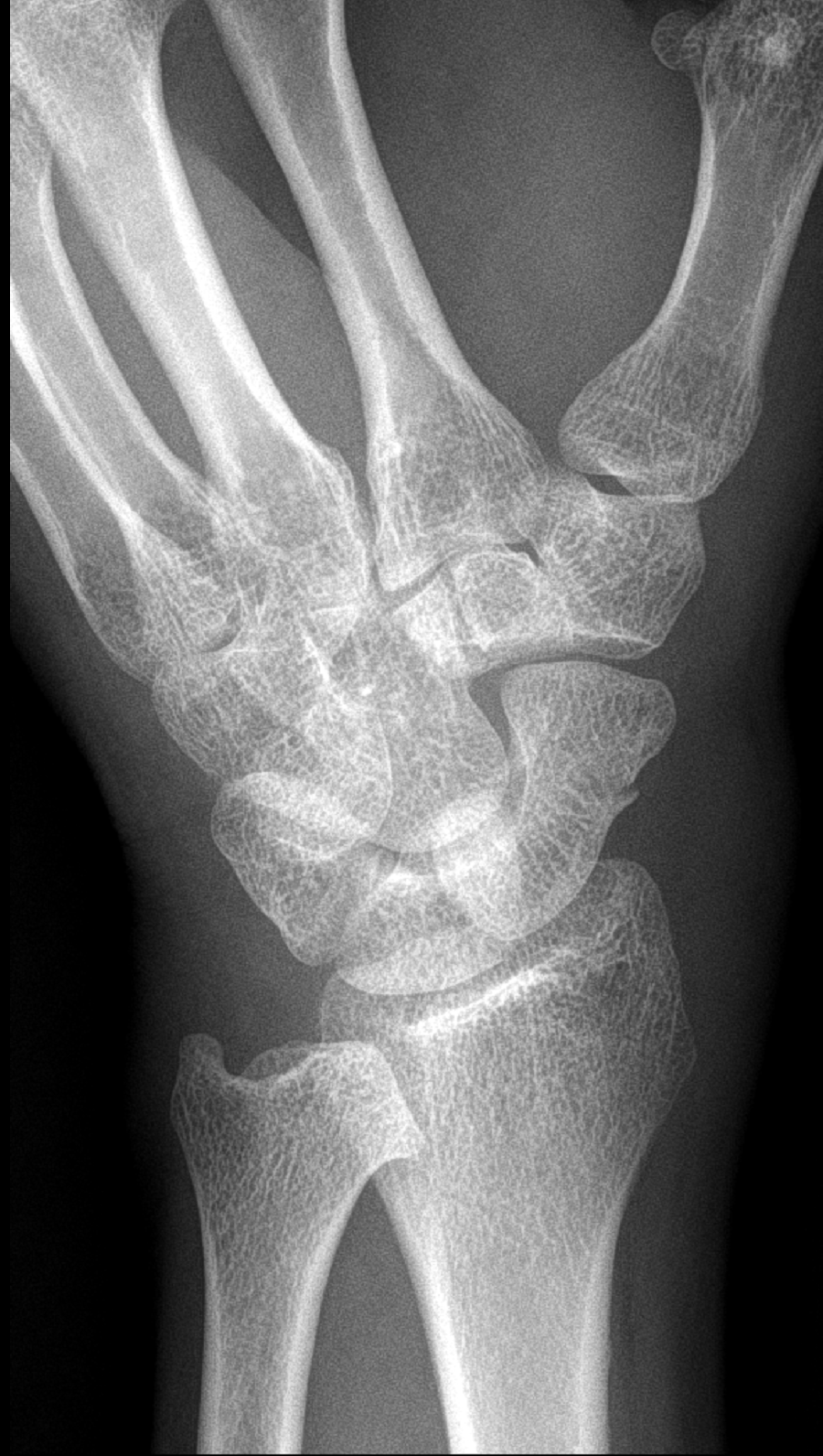 scaphoid-radiopedia-Oblique Object Detection Dataset by NiLuan