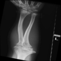 Bone fracture detection project thumbnail