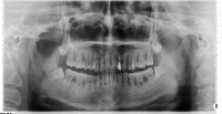 periodontitis project thumbnail