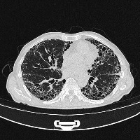 lung project thumbnail