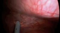 Laparoscopic  appendectomy surgery project thumbnail