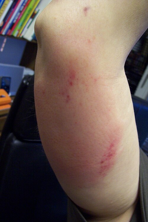 Bite & Rash Classifier Classification Model by clinicvision