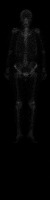 Bone Scan Cancer Segmentation project thumbnail