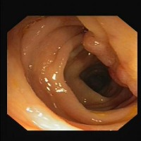 Colonoscopy project thumbnail
