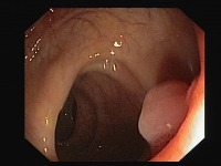gastric cancer detection using colonoscopy videos project thumbnail