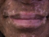 vitiligo project thumbnail