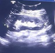 Ultrasound_Detection project thumbnail
