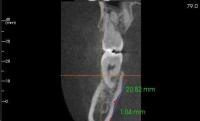 inferior alveolar bone fragm project thumbnail