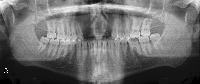 teeth crown project thumbnail