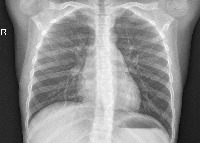 pneumonia detection using machine learning project thumbnail