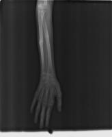 Human bone fracture project thumbnail