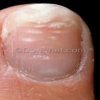 WHITE_SPOTS ON NAILS. project thumbnail