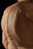 Kyphosis project thumbnail