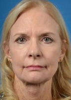 Botox face prediction project thumbnail