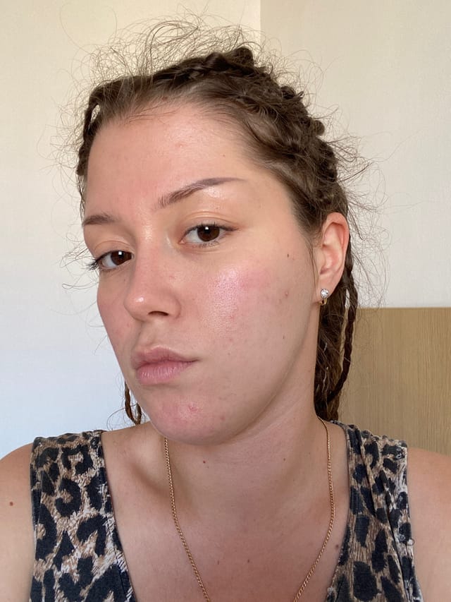 Skin Analysis Demo Object Detection Dataset By Izzas