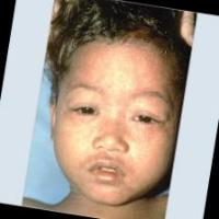 Measles project thumbnail