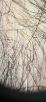 Hair Follicle Opening Detection project thumbnail