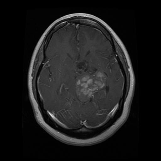MRI Brain Tumor Classification Instance Segmentation Model by BenT