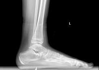 gout_foot project thumbnail