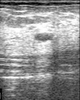 breast ultrasound raw project thumbnail