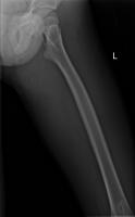 Bone Tumor Project project thumbnail