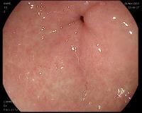 Detection anomalies gastro project thumbnail