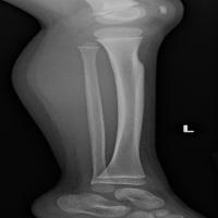Bone Tumor project thumbnail